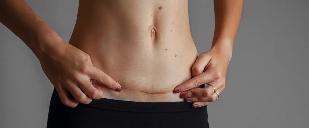 cicatrice de césarienne comment en prendre soin