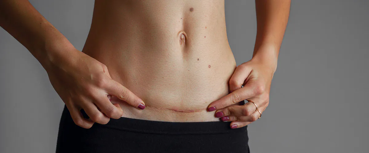 cicatrice de césarienne comment en prendre soin